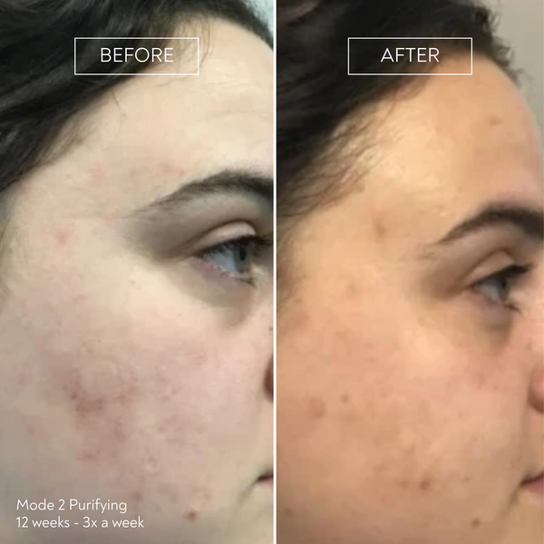 PRO by Déesse PRO LED Mask