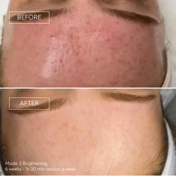 PRO by Déesse PRO LED Mask
