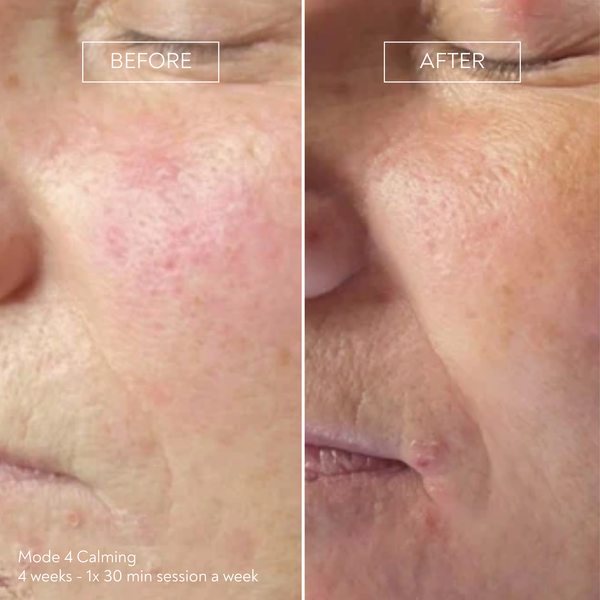 PRO by Déesse PRO LED Mask