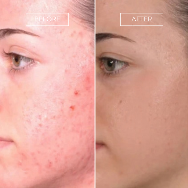PRO by Déesse PRO LED Mask