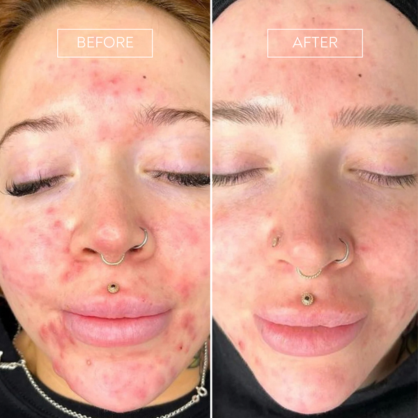 PRO by Déesse PRO LED Mask