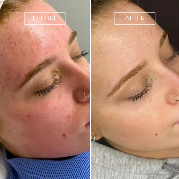 PRO by Déesse PRO LED Mask