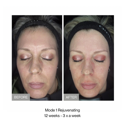 Before and after comparison of a woman's face with text indicating treatment details -  rejuvenating  red light therapy treatment.