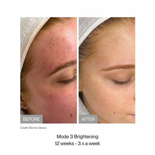 Before and after skin treatment showing improvement with 'Mode 3 Brightening' treatment over 12 weeks.