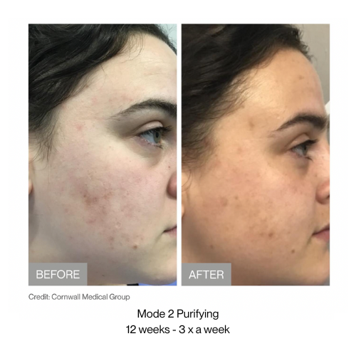 Before and after skin treatment comparison showing improvement in skin texture and clarity.