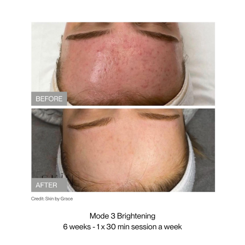 Before and after comparison of skin after green light therapy treatment with text indicating mode, duration, and frequency.