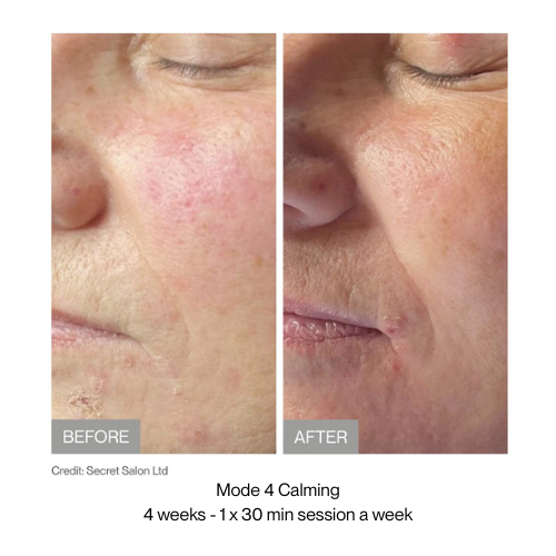 Before and after comparison of skin treatment with 'Mode 4 Calming' text.